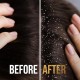 Pantene shampoo 190ml andi dandruff